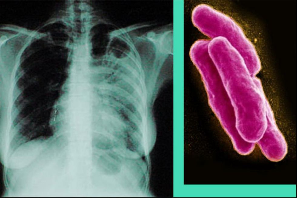 Прогрессирование туберкулеза. Микобактерия туберкулеза.